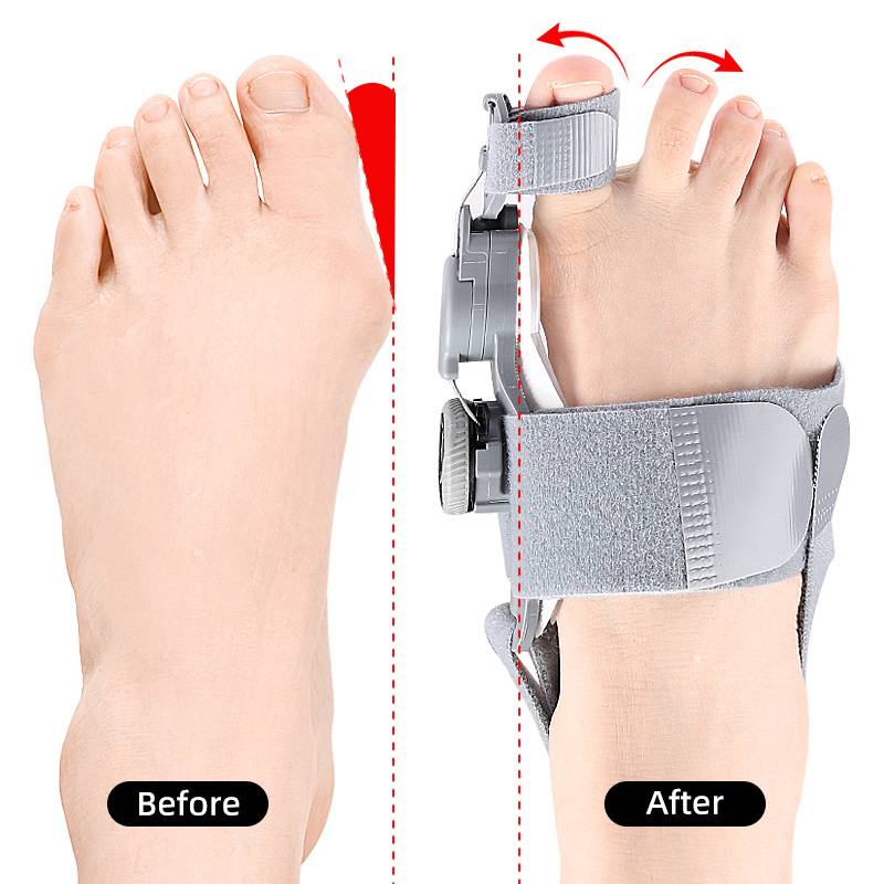 Natural Bunions Corrector Toe Spacer – Belro